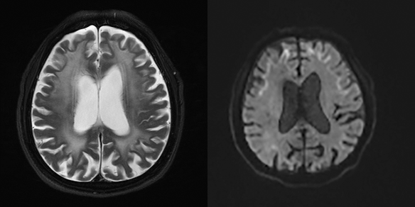 図3：NIIDの頭部MRI所見の写真