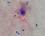 喀痰中の肺炎球菌